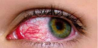 Infection with pink eye has increased to 85 new cases in Lahore.