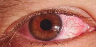 Sindh issues a directive to combat the increase in pink eye infections.