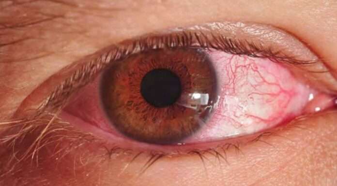 Sindh issues a directive to combat the increase in pink eye infections.